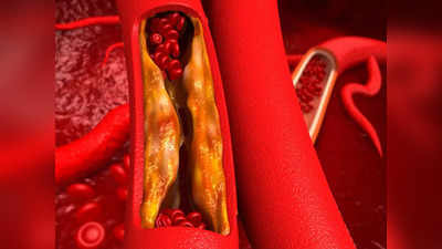 Calcification in arteries: శరీరంలో కాల్షియం స్థాయిలు పెరిగితే.. హై కొలెస్ట్రాల్‌ కంటే రిస్క్‌ ఎక్కువ..!