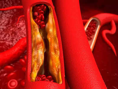 Calcification in arteries: శరీరంలో కాల్షియం స్థాయిలు పెరిగితే.. హై కొలెస్ట్రాల్‌ కంటే రిస్క్‌ ఎక్కువ..!