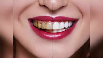 Teeth Whitening Foods: दांतों में जमा पीली परत को खोद-खोदकर निकाल देंगी ये 5 लाल चीजें, चमचमाएगी बत्तीसी