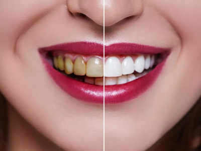 Teeth Whitening Foods: दांतों में जमा पीली परत को खोद-खोदकर निकाल देंगी ये 5 लाल चीजें, चमचमाएगी बत्तीसी