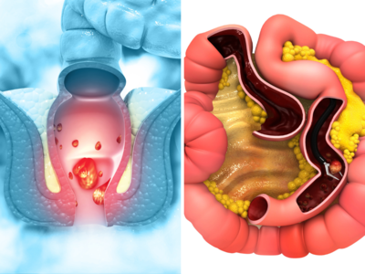 शौचाच्या जागी गाठ व ब्लीडिंग होते? मुळव्याध आहे की कोलोरेक्टल कॅन्सरची सुरूवात, असा ओळखा दोन्ही लक्षणांतला फरक