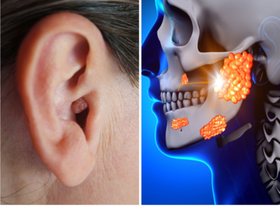 कान की रसौली का इलाज क्या है? कान की हड्डियां तोड़कर बहरा कर देगी छोटी गांठ, तुरंत करें ये 5 काम