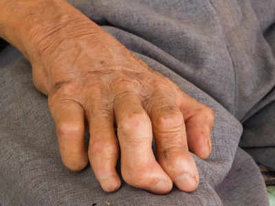Leprosy causes : ముట్టుకోవడం వల్ల కుష్టు వ్యాధి వస్తుందా..