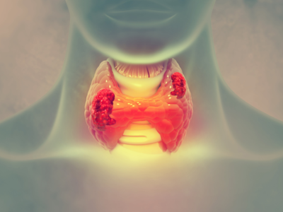 Thyroid Cancer: தைராய்டு புற்றுநோய் அறிகுறிகள். யாருக்கு அதிகமாக வர வாய்ப்பு?