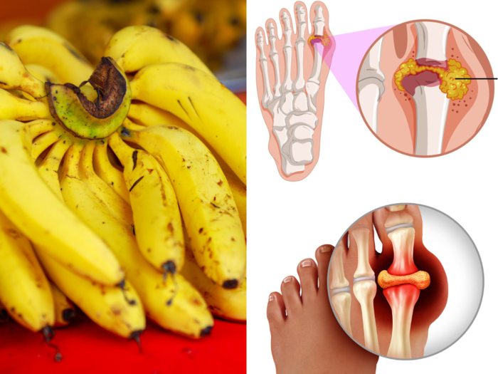 7 fructose rich fruits that increase uric acid level and cause gout and kidney stones, according to cdc