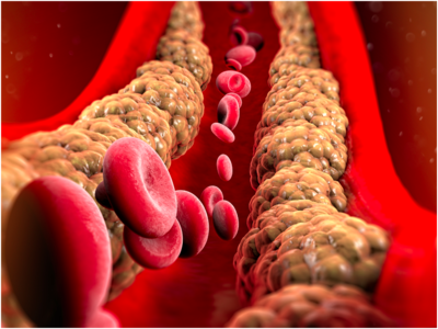 Cholesterol: ಕೊಲೆಸ್ಟ್ರಾಲ್‌ಗೆ ಆಯುರ್ವೇದ ಚಿಕಿತ್ಸೆ ಏನು?