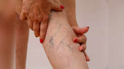 Varicose veins : నిలబడినప్పుడు కాళ్ళలో నొప్పితో పాటు ఈ సమస్య కనిపిస్తుందా.. జాగ్రత్త..