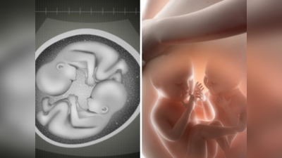 जुळ्या बाळांपैकी गर्भातच एक होऊ शकते गायब, तुम्हाला हा आजार तर नाही?