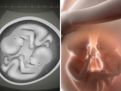 जुळ्या बाळांपैकी गर्भातच एक होऊ शकते गायब, तुम्हाला हा आजार तर नाही?