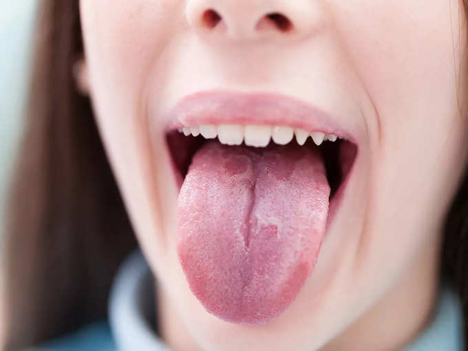 Home Remedies For Sore Tongue