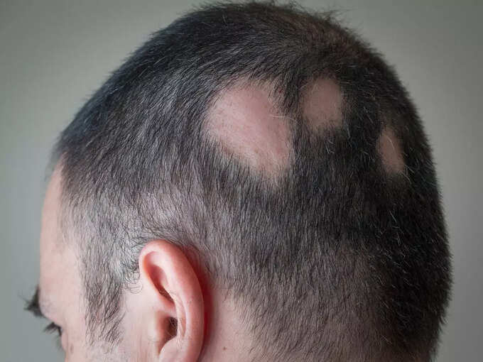 एलोपेसिया एरीटा क्या है? एलोपेसिया एरीटा क्या है?