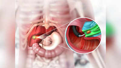 gallstones diet : பித்தப்பை கற்கள் இருந்தா  இறைச்சி சாப்பிடலாமா?  என்ன சாப்பிடணும், என்ன தவிர்க்கணும்?