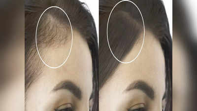 Hair Thinning in 30s: ৩০ পেরতেই কেন চুল উঠে মাথা ফাঁকা হয়ে যাচ্ছে? কী ভাবে ফিরে পাবেন ঘন কালো চুল, জানালেন চিকিৎসক