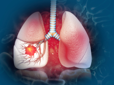 Lung Cancer Remedies : फुफ्फुसे आतून पोखरून निकामी करतात या 3 गोष्टी, कॅन्सरपासून बचावासाठी लगेच करा हे 5 उपाय