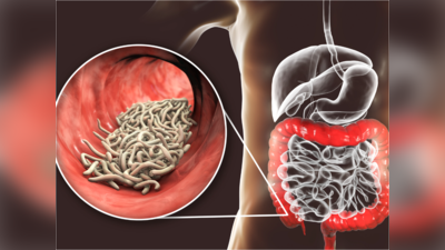 ಕರುಳಿನಲ್ಲಿ ಅಂಟಿರುವ ಈ ಹುಳುಗಳು ದೇಹದ ರಕ್ತವನ್ನೆಲ್ಲಾ ಹೀರುತ್ತಂತೆ