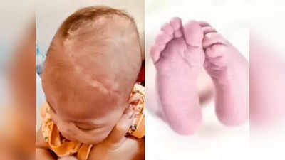 Infant With Skull Defect: ನೆತ್ತಿಯ ಚರ್ಮವೇ ಇಲ್ಲದೆ ಜನಿಸಿದ ಮಗು: ಮೆದುಳು ಕಾಣಿಸುತ್ತಿದ್ದ ಶಿಶುವಿಗೆ ಶಸ್ತ್ರಚಿಕಿತ್ಸೆ