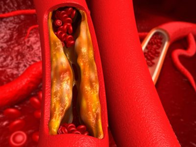 How to Reduce LDL Cholesterol : கெட்ட கொழுப்பை கரைத்து வெளியேற்றும் 5 அற்புத உணவுகள்