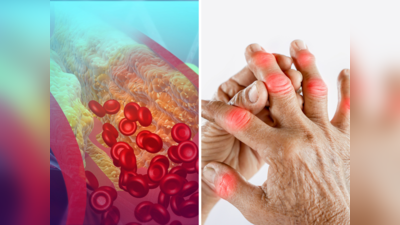 हात आणि हातांच्या बोटांवरून ओळखा घाणेरड्या कोलेस्ट्रॉलची लक्षणे