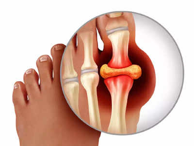 High Uric Acid : யூரிக் அமிலம் அதிகமாகி கீழ்வாத பிரச்சினையால அவதிப்பட்டா நீங்க இந்த 4  பழங்களை சாப்பிடுங்க...