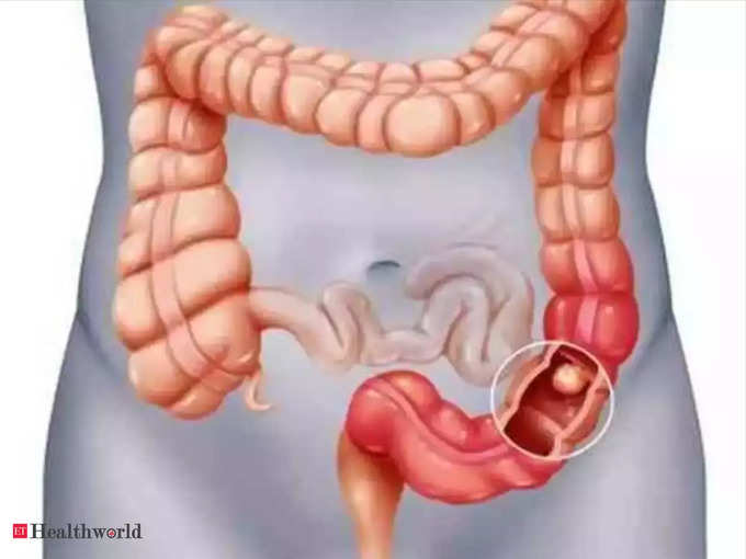 பெருங்குடல் புற்றுநோயின் ஆபத்து காரணிகள்