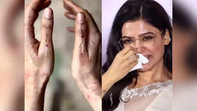 Samantha Ruth Prabhu: क्या सिटाडेल के सेट पर सामंथा को लगी है चोट? खून से लथपथ जख्मी हाथ देख दर्द में फैंस
