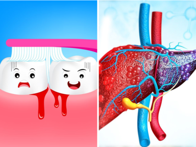 Fatty Liver Disease Symptoms: ब्रश के समय दांतों से आता है खून? फैटी लीवर के इन 13 लक्षणों को न करें नजरअंदाज