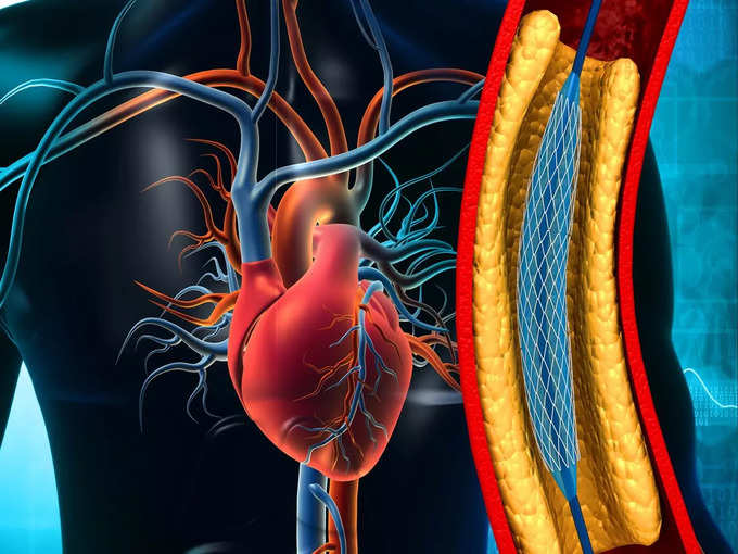 धमनियों में ब्लॉकेज होना क्या है (what is artery blockage)