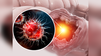 Colorectal Cancer Signs: आंतें ब्लॉक कर देता है कोलोरेक्टल कैंसर, सिर्फ टॉयलेट में दिखते हैं ये 6 लक्षण