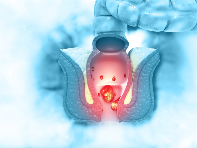 bleeding during bowel movements
