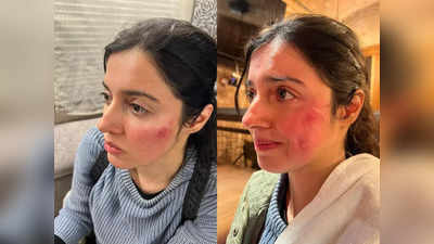 Divya Khosla Injured: एक्शन सीन के दौरान बुरी तरह घायल हुईं दिव्या खोसला, 5 तस्वीरें देख दहल उठेगा आपका भी दिल