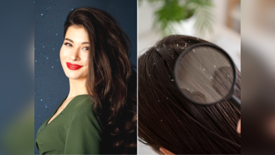 Dandruff Tips: અનેક પ્રયત્નો છતાં ડેન્ડ્રફથી છૂટકારો નથી મળી રહ્યો? તો ડાયટમાં કરો આ ફેરફાર; ડર્મેટોલોજીસ્ટની ટિપ્સ