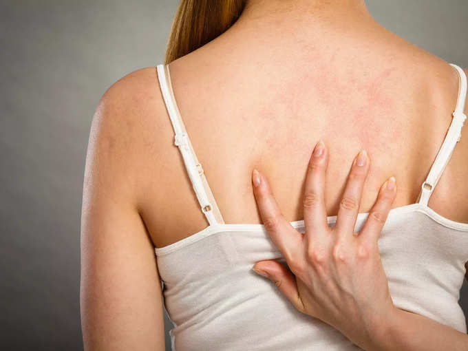 ​heat rash ஹீட் ரேஷ் அறிகுறிகள் எப்படி இருக்கும்?​