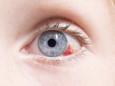 Red Eyes Causes: नाजुक आंखों को छलनी कर देंगी 5 गंदी आदतें, आज ही छोड़ें, वरना उतर आएगा खून