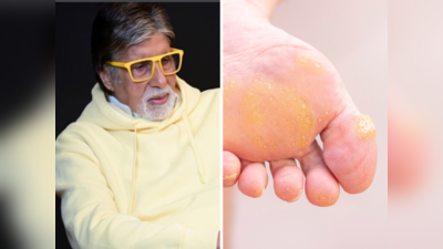 ​Amitabh Bachchan झेल रहे हैं भयानक दर्द,पंजे में हुआ Callus, ये हैं इसके 5 कारण और इलाज