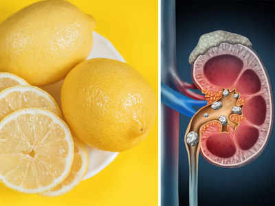 Kidney Stones: কিডনি স্টোন হলেই কি কাটাছেঁড়া করতে হয়?  ঘরোয়া এই প্রতিকার মানলে সমাধান হবে সহজেই