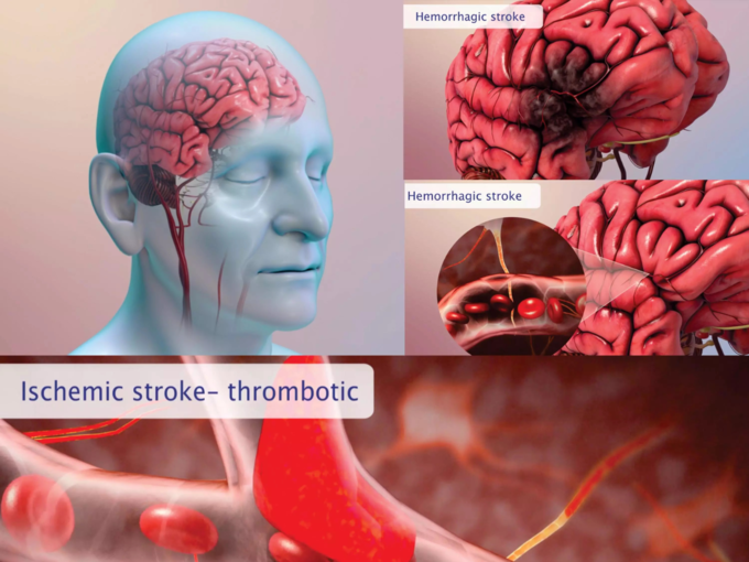 ​பக்க வாதத்தின் வகைகள் (stroke types)