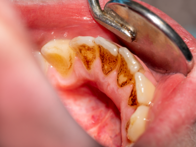 Teeth Stains:പല്ലിലെ പ്ലാക്കും ചായക്കറയും കളയാന്‍ചില വീട്ടുവൈദ്യം​