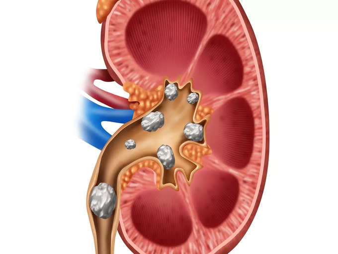 ​৩. কিডনিতে স্টোন হিসাবে জমে​