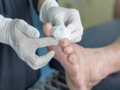 Diabetic Foot Ulcer: পায়ের ক্ষত সারছে না? ডায়াবেটিক ফুট আলসার নয় তো? রোগের কারণ ও চিকিৎসা জানুন
