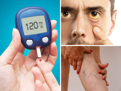 साइलेंट किलर Diabetes के त्वचा पर दिखते हैं 10 अजीब लक्षण, आप भी कर लें चेक