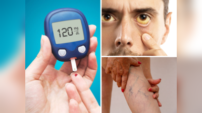 Diabetes Symptoms: त्वचा पर दिखते हैं डायबिटीज के 10 गंभीर लक्षण, नहीं दिया ध्यान तो तेजी से बढ़ेगा Blood Sugar