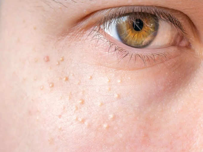 त्वचा पर दिखने वाले डायबिटीज के अन्य लक्षण 