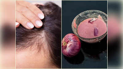 Onion Juice For Hair: পেঁয়াজের রস মাখলেই কি টাকে নতুন চুল গজায়? উত্তর দিলেন চিকিৎসক