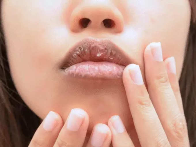 how to get rid of dry lips at home