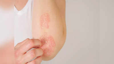 Psoriasis: వేసవిలో సోరియాసిస్‌ తగ్గాలంటే.. ఈ జాగ్రత్తలు తీసుకోండి..! 