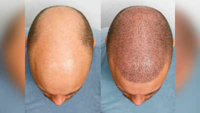 Hereditary Hair Loss : பரம்பரையே வழுக்கை தலையா, உங்களுக்கு வராம தடுக்க முடியுமா, என்ன செய்யணும்?