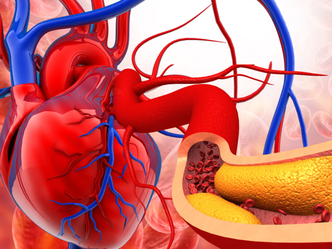  इस्केमिक हृदयरोग म्हणजे काय? (What is Coronary Heart Disease)