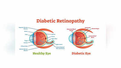 World Homeopathy day 2023 : நீரிழிவு ரெட்டினோபதிக்கு ஹோமியோபதி சிகிச்சையில் நிரந்தர தீர்வு இருக்கா?