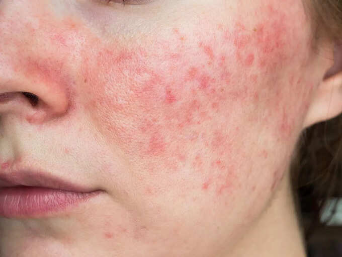 रोजेशिया (Rosacea)