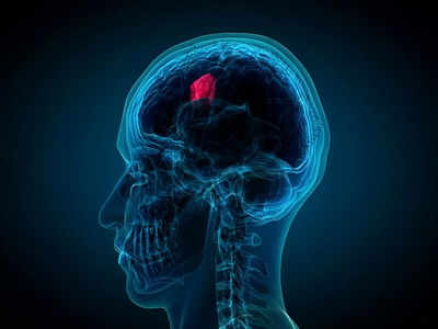 Brain tumor risks:బ్రెయిన్‌ ట్యూమర్‌ రావడానికి 5 కారణాలు ఇవే..!